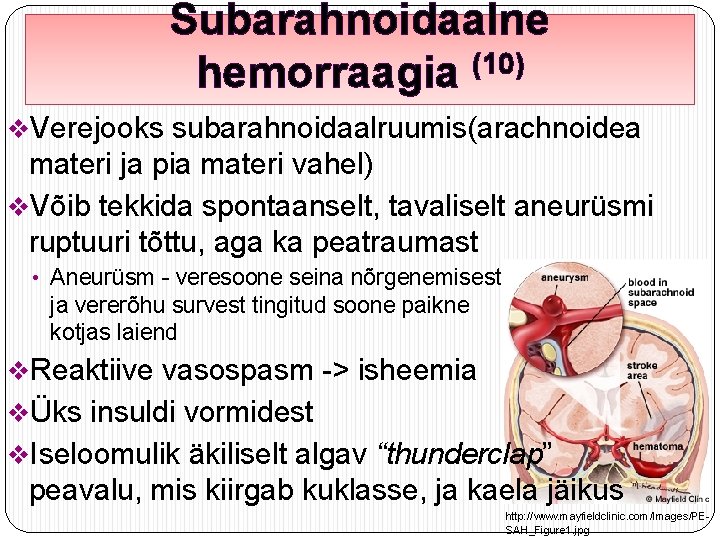 Subarahnoidaalne hemorraagia (10) v. Verejooks subarahnoidaalruumis(arachnoidea materi ja pia materi vahel) v. Võib tekkida