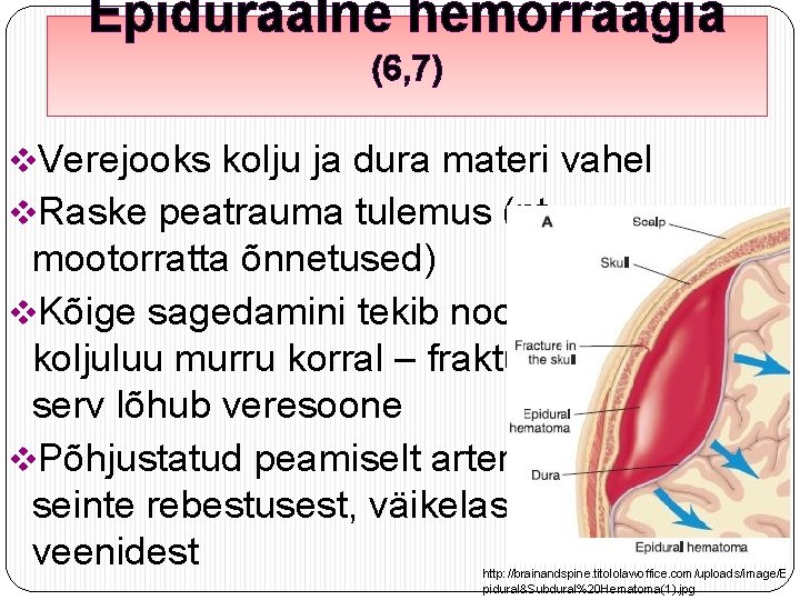 Epiduraalne hemorraagia (6, 7) v. Verejooks kolju ja dura materi vahel v. Raske peatrauma