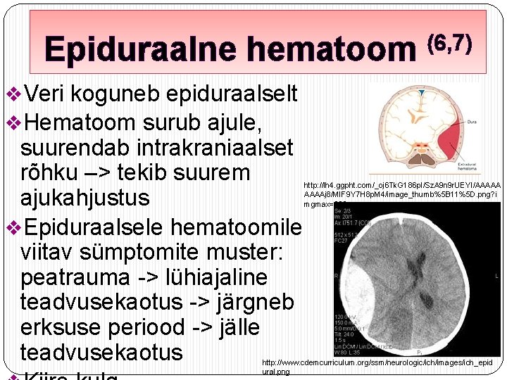 Epiduraalne hematoom (6, 7) v. Veri koguneb epiduraalselt v. Hematoom surub ajule, suurendab intrakraniaalset