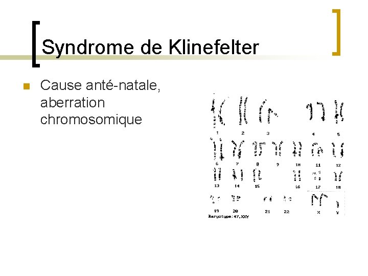 Syndrome de Klinefelter n Cause anté-natale, aberration chromosomique 