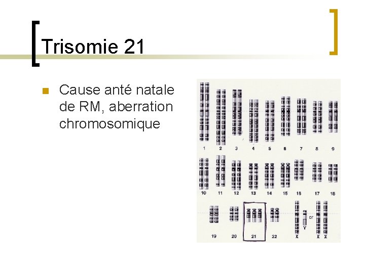 Trisomie 21 n Cause anté natale de RM, aberration chromosomique 