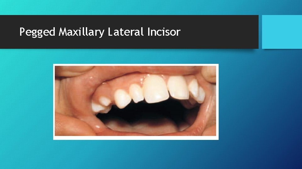 Pegged Maxillary Lateral Incisor 