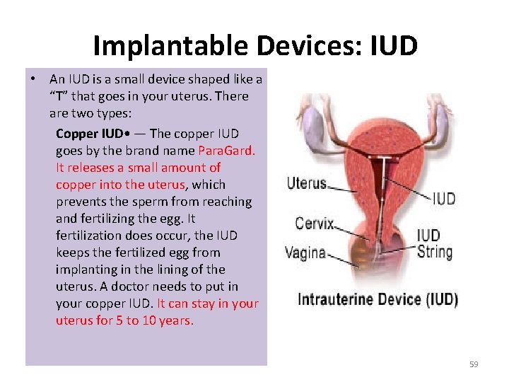 Implantable Devices: IUD • An IUD is a small device shaped like a “T”