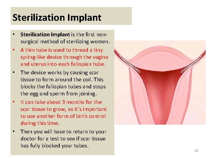 Sterilization Implant • Sterilization Implant is the first nonsurgical method of sterilizing women. •