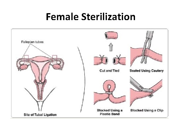 Female Sterilization 