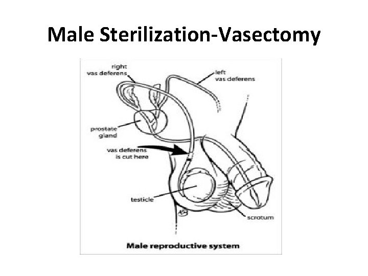 Male Sterilization-Vasectomy 