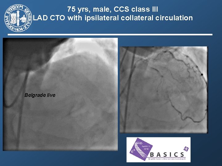 75 yrs, male, CCS class III LAD CTO with ipsilateral collateral circulation Belgrade live