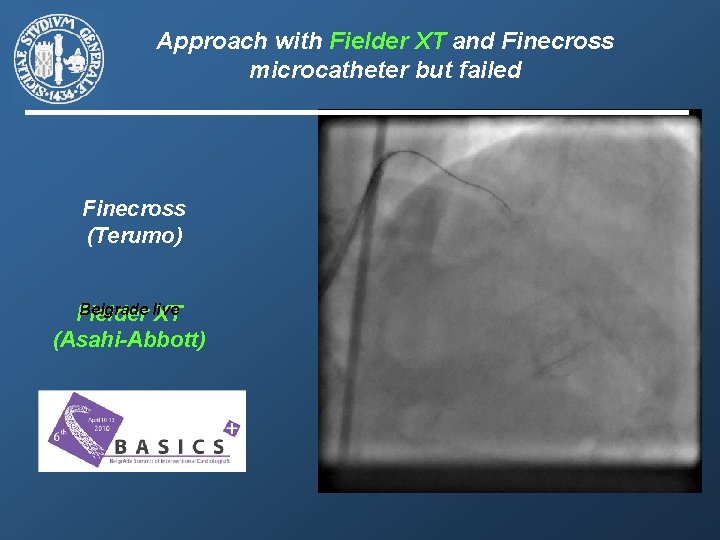 Approach with Fielder XT and Finecross microcatheter but failed Finecross (Terumo) Belgrade live Fielder