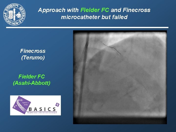 Approach with Fielder FC and Finecross microcatheter but failed Finecross (Terumo) Fielder FC (Asahi-Abbott)