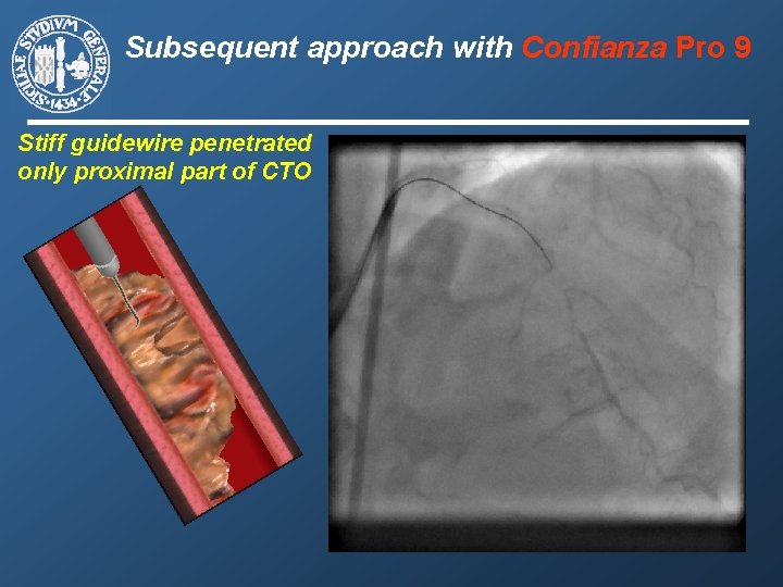 Subsequent approach with Confianza Pro 9 Stiff guidewire penetrated only proximal part of CTO