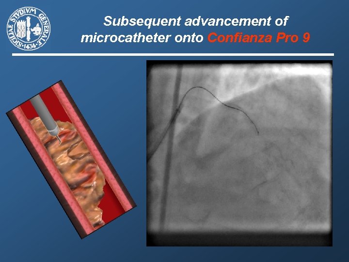 Subsequent advancement of microcatheter onto Confianza Pro 9 