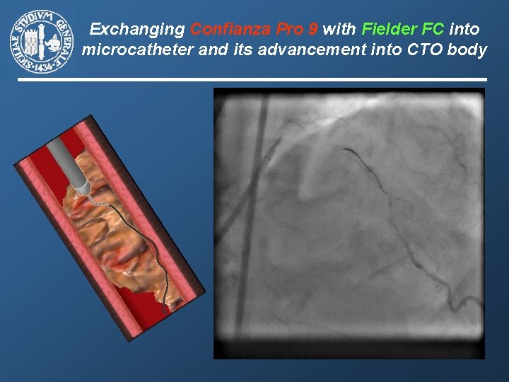 Exchanging Confianza Pro 9 with Fielder FC into microcatheter and its advancement into CTO