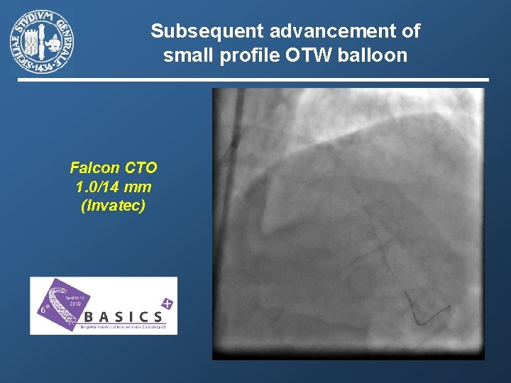 Subsequent advancement of small profile OTW balloon Falcon CTO 1. 0/14 mm (Invatec) 