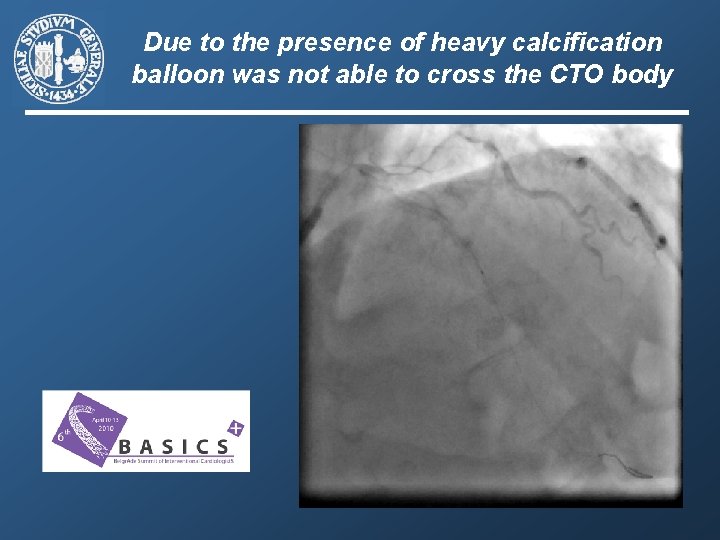 Due to the presence of heavy calcification balloon was not able to cross the