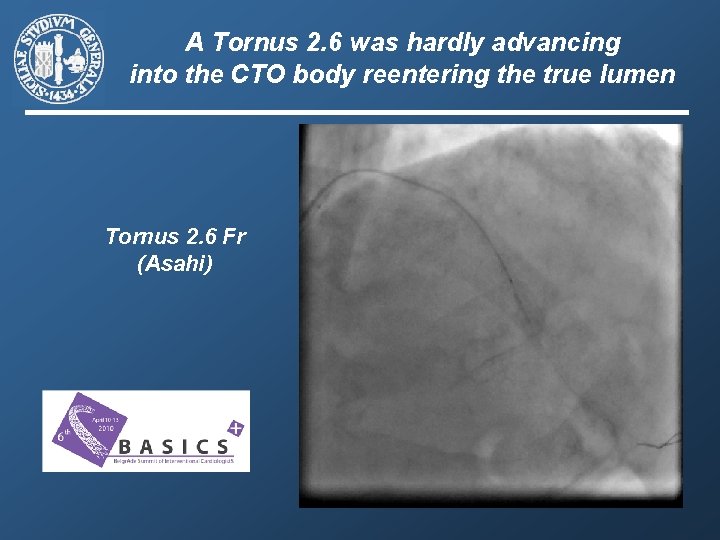 A Tornus 2. 6 was hardly advancing into the CTO body reentering the true