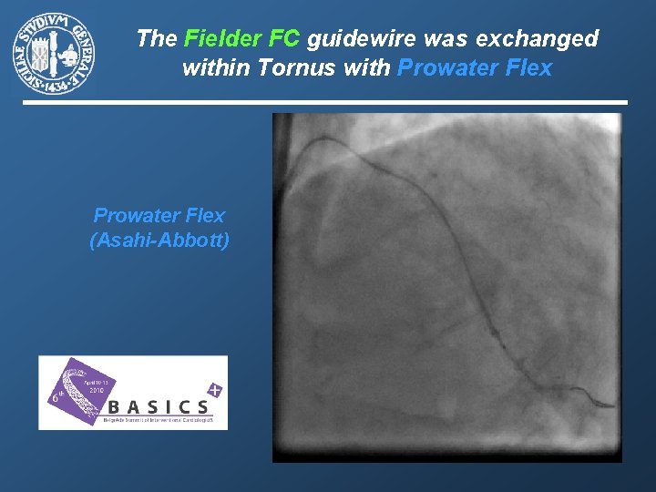 The Fielder FC guidewire was exchanged within Tornus with Prowater Flex (Asahi-Abbott) 