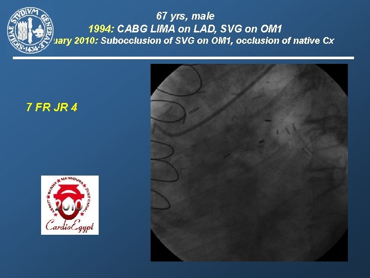 67 yrs, male 1994: CABG LIMA on LAD, SVG on OM 1 January 2010: