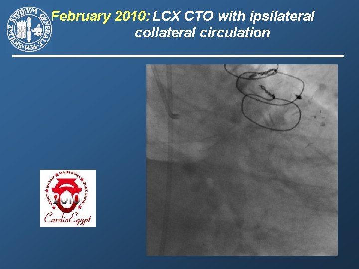 February 2010: LCX CTO with ipsilateral collateral circulation 