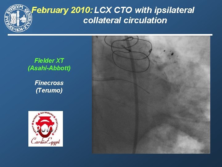 February 2010: LCX CTO with ipsilateral collateral circulation Fielder XT (Asahi-Abbott) Finecross (Terumo) 