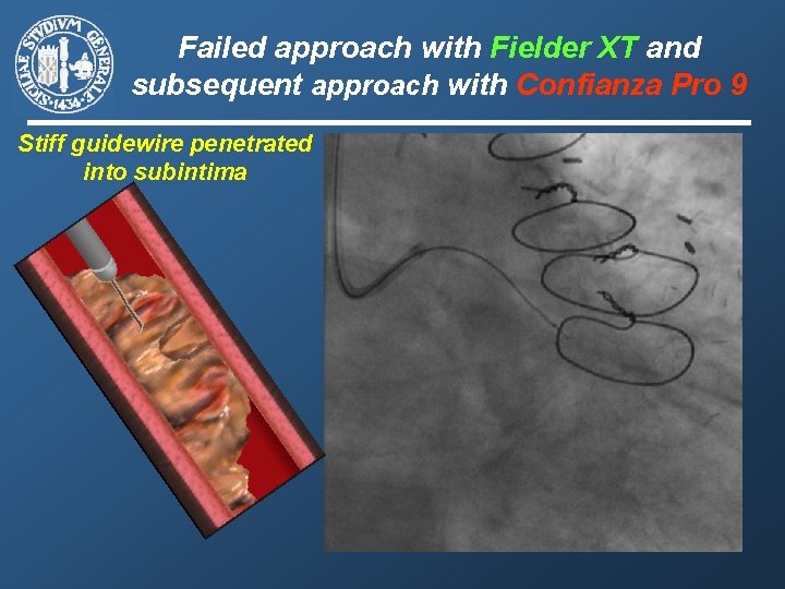 Failed approach with Fielder XT and subsequent approach with Confianza Pro 9 Stiff guidewire