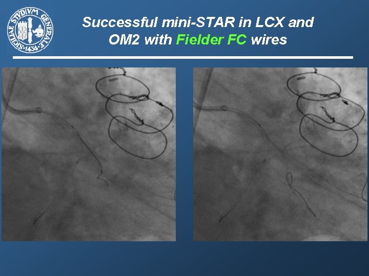 Successful mini-STAR in LCX and OM 2 with Fielder FC wires 