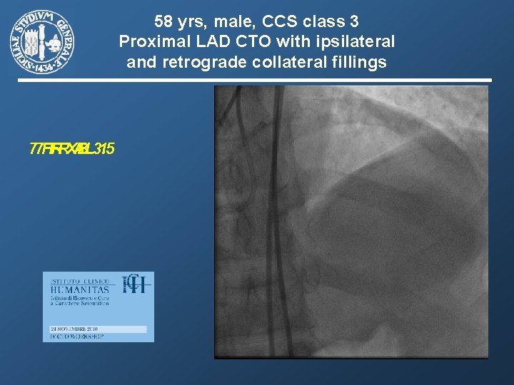 58 yrs, male, CCS class 3 Proximal LAD CTO with ipsilateral and retrograde collateral