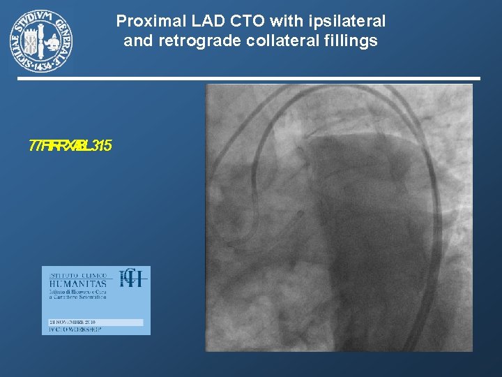 Proximal LAD CTO with ipsilateral and retrograde collateral fillings 77 FR FRXB AL 3.