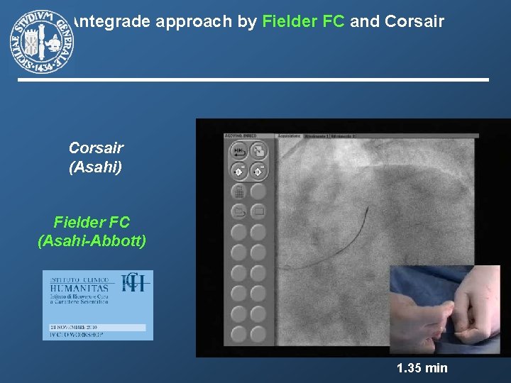 Antegrade approach by Fielder FC and Corsair (Asahi) Fielder FC (Asahi-Abbott) 1. 35 min