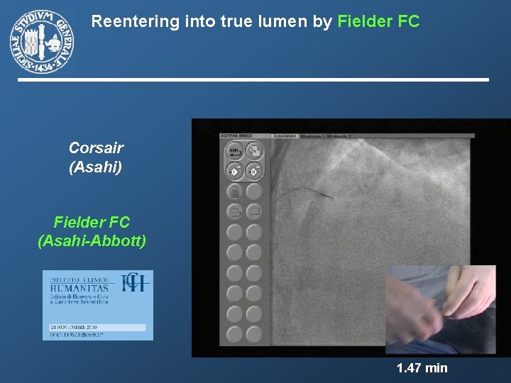 Reentering into true lumen by Fielder FC Corsair (Asahi) Fielder FC (Asahi-Abbott) 1. 47