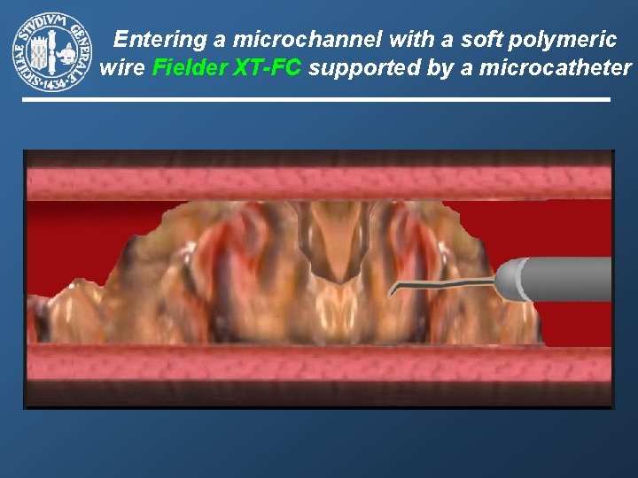 Entering a microchannel with a soft polymeric wire Fielder XT-FC supported by a microcatheter