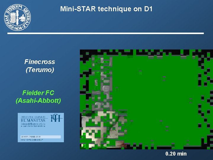 Mini-STAR technique on D 1 Finecross (Terumo) Fielder FC (Asahi-Abbott) 0. 20 min 