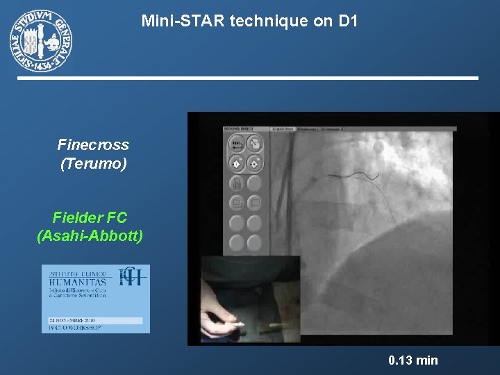 Mini-STAR technique on D 1 Finecross (Terumo) Fielder FC (Asahi-Abbott) 0. 13 min 