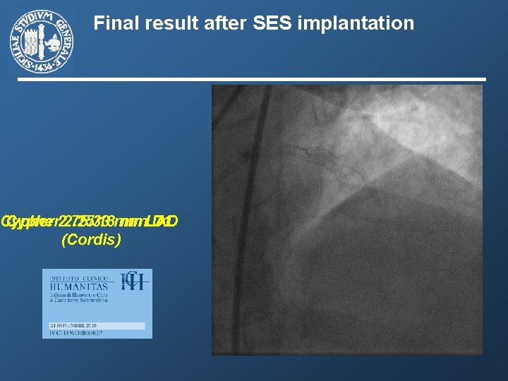 Final result after SES implantation Cypher 2. 75/33 2. 25/18 mm mm. LAD D