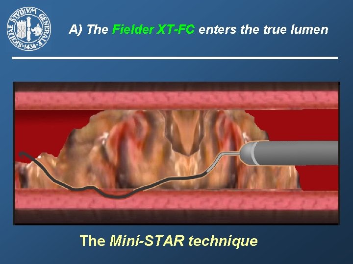 A) The Fielder XT-FC enters the true lumen The Mini-STAR technique 