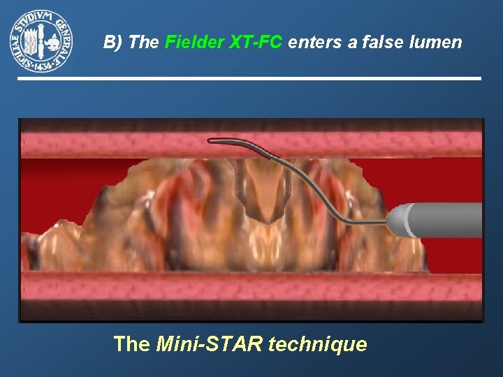 B) The Fielder XT-FC enters a false lumen The Mini-STAR technique 