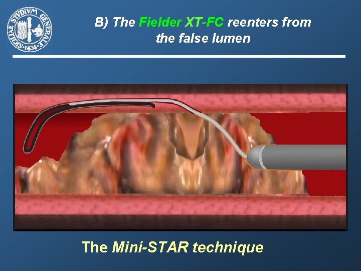 B) The Fielder XT-FC reenters from the false lumen The Mini-STAR technique 