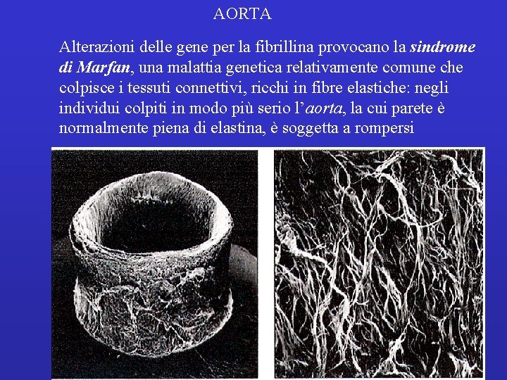 AORTA Alterazioni delle gene per la fibrillina provocano la sindrome di Marfan, una malattia