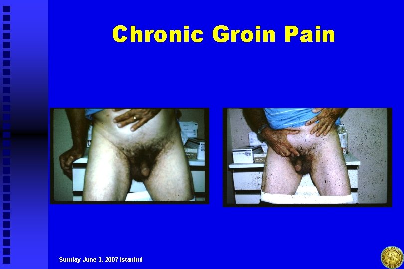 Chronic Groin Pain Sunday June 3, 2007 Istanbul 