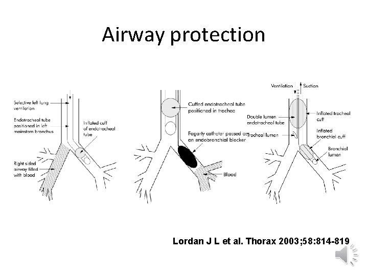 Airway protection Lordan J L et al. Thorax 2003; 58: 814 -819 