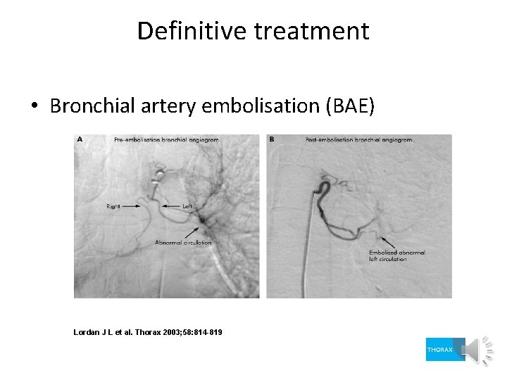 Definitive treatment • Bronchial artery embolisation (BAE) Lordan J L et al. Thorax 2003;