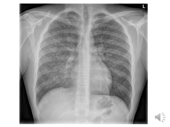 CXR 
