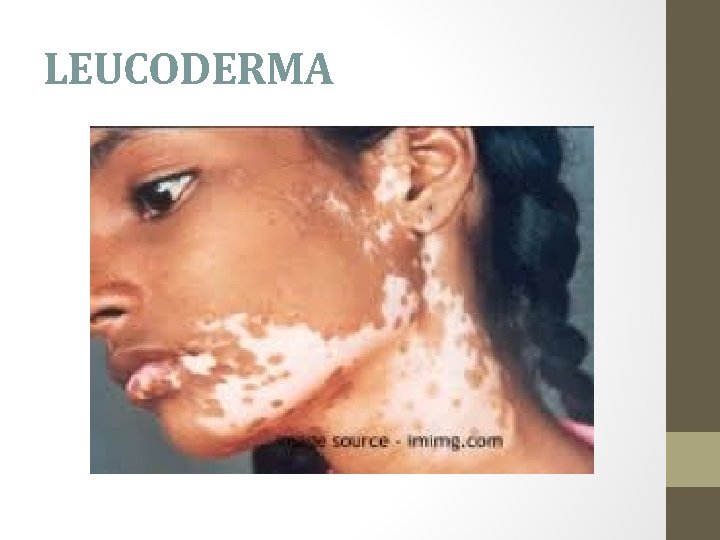 LEUCODERMA 