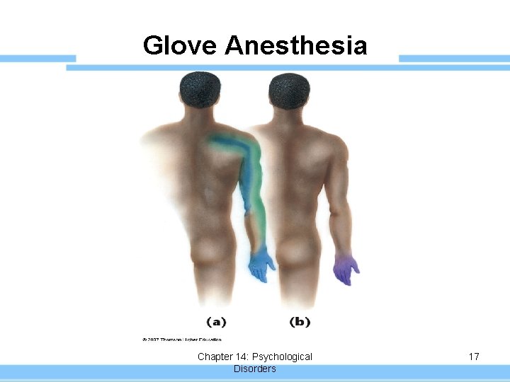 Glove Anesthesia Chapter 14: Psychological Disorders 17 