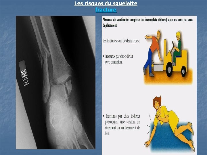 Les risques du squelette fracture 19 