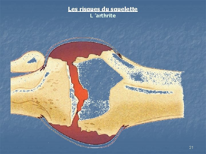 Les risques du squelette L ’arthrite 21 