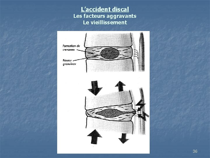 L’accident discal Les facteurs aggravants Le vieillissement 36 