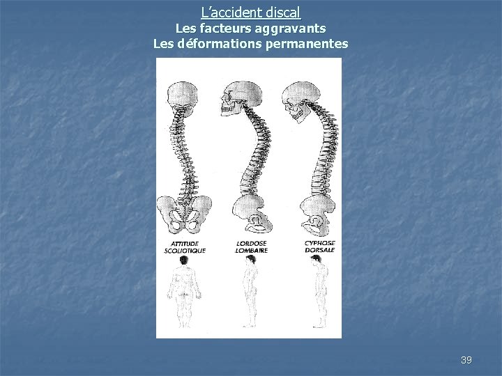 L’accident discal Les facteurs aggravants Les déformations permanentes 39 