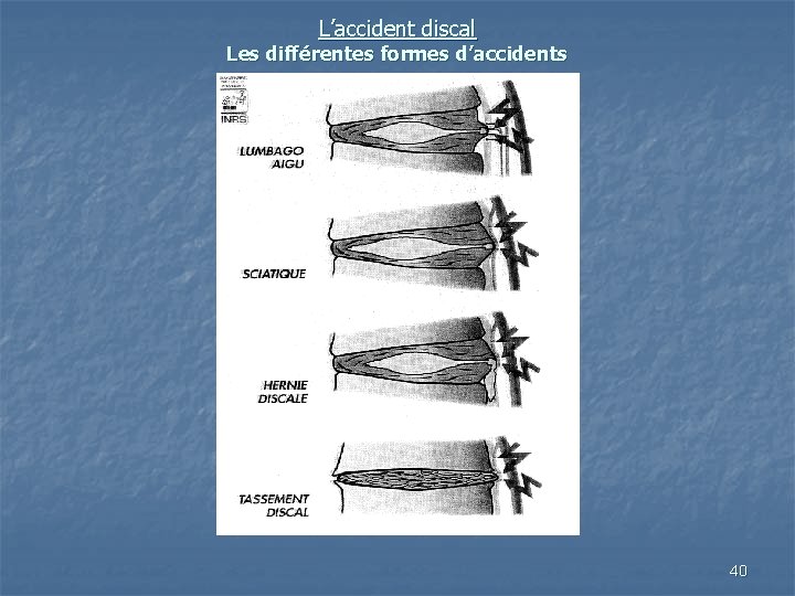 L’accident discal Les différentes formes d’accidents 40 