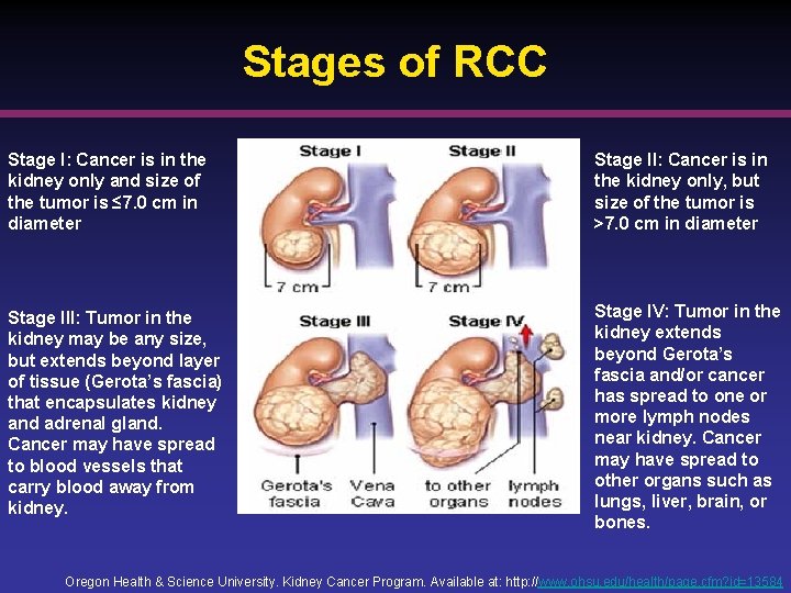 Stages of RCC Stage I: Cancer is in the kidney only and size of