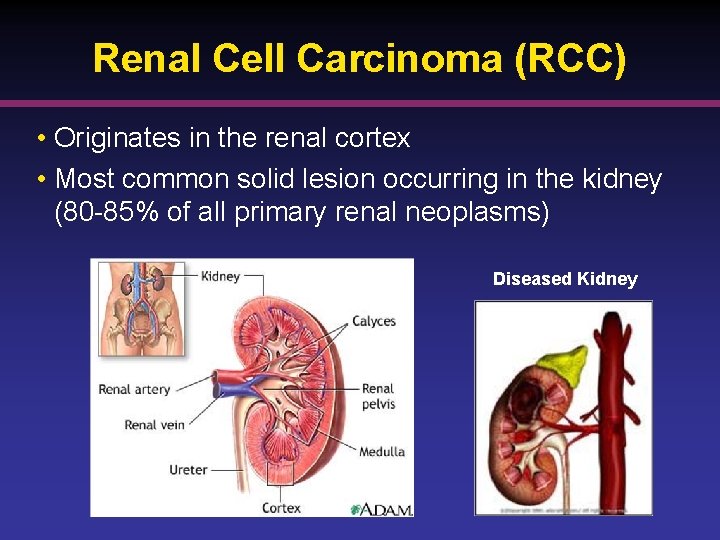 Renal Cell Carcinoma (RCC) • Originates in the renal cortex • Most common solid